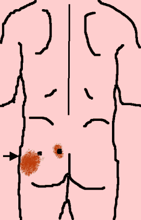 Piriformis Pain Patterns and Trigger Points