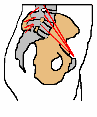 The Ballance between the Psoas and Multifidis
muscles
